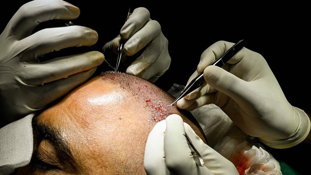 No Two Hair Transplant Surgeries Are the Same