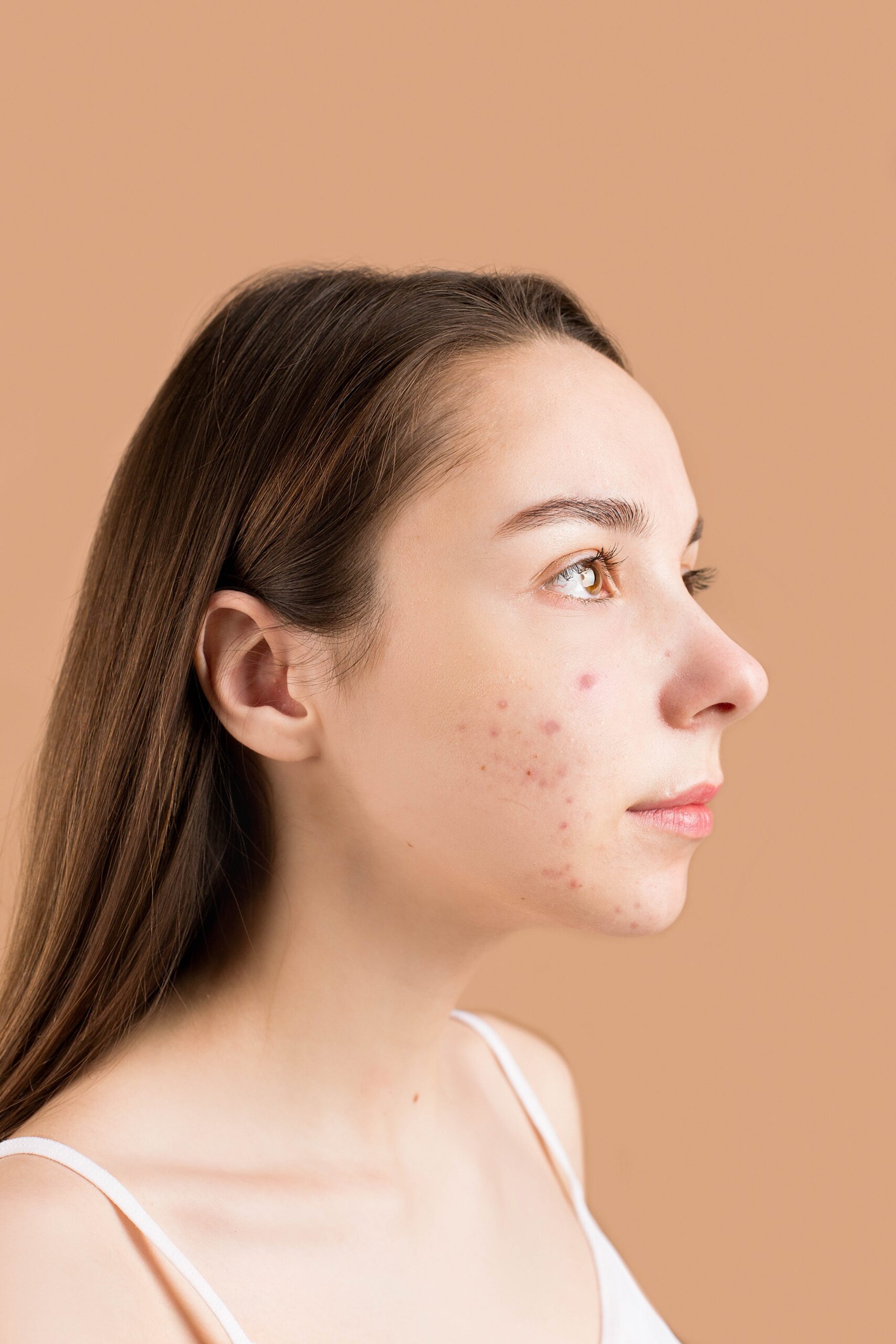 Salicylic Acid The Go-To Solution for Acne-Prone Skin